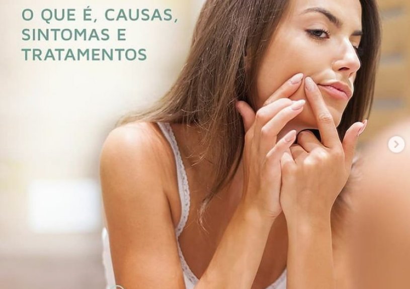 ACNE: O que é , suas causas e sintomas ACNE: O que é , suas causas e sintomas