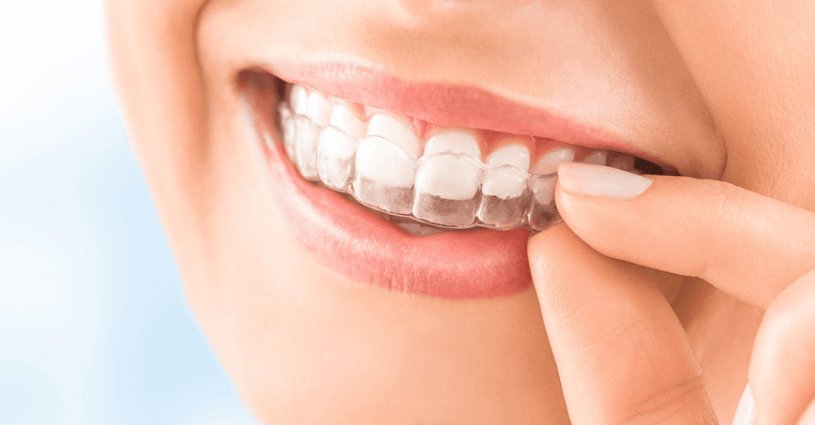 Alinhadores invisíveis, uma excelente alternativa ao aparelho ortodôntico fixo Alinhadores invisíveis, uma excelente alternativa ao aparelho ortodôntico fixo