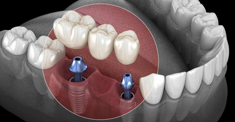 Cuide com carinho do seu implante! Cuide com carinho do seu implante!