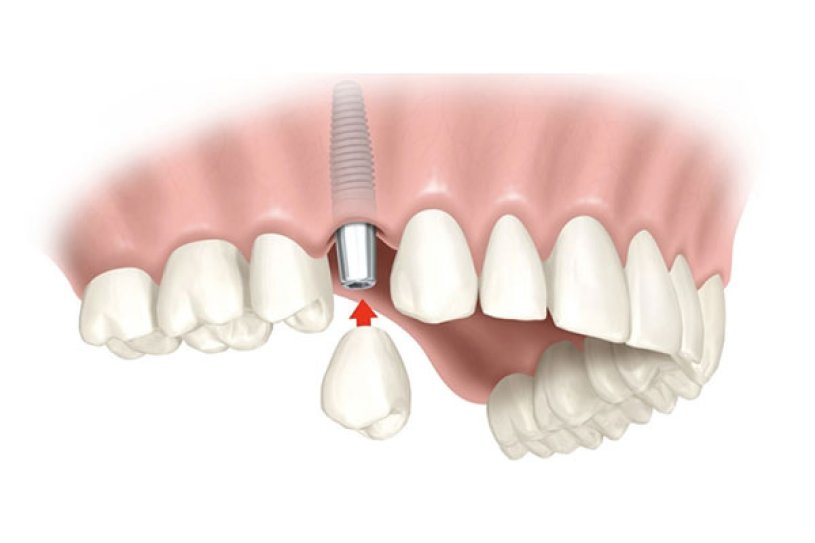 Implantes dentais com carga imediata! Implantes dentais com carga imediata!