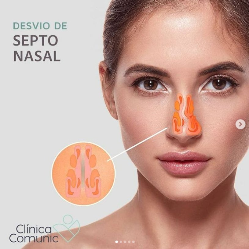 Meu otorrinolaringologista disse que tenho desvio de septo nasal, e afinal o que é Meu otorrinolaringologista disse que tenho desvio de septo nasal, e afinal o que é